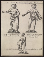 view Three human figures, each with superfluous body parts growing from their bodies. Engraving, 16--.