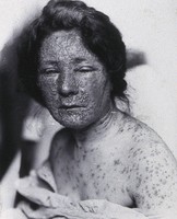 view Friern Hospital, London: a woman's arms with spots, possibly smallpox. Photograph, 1890/1910.