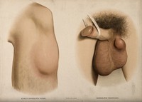 view A section of leg with a swelling on the shin below the knee; and male genitalia with a lump on the testicles. Chromolithograph, c. 1888.