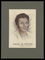 view A cholera victim with a typical facial appearance. Watercolour by E. Schwarz, 1920/1950 (?), after Robert Froriep, ca. 1831.