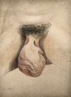 view Female genitalia showing severely diseased tissue and hypertrophy of the clitoris. Watercolour by C. D'Alton, ca. 1857.