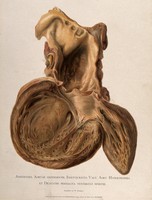 view A diseased heart, showing an aortic aneursym with an enlarged left ventricle. Chromolithograph by W. Gummelt, ca. 1897.