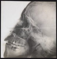 view X-ray of a skull, in profile. Photograph, ca. 1915.