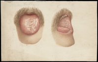 view Tongue, mouth, and moustache of a man with skin disease: two figures. Watercolour, 1892.