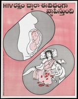 view A foetus in the womb of a woman and a nurse delivering the baby below representing a warning about the dangers of passing on HIV through pregnancy by Spitnacs, Societal Projects Information Training Networking and Consultancy Services. Colour lithograph, ca 1997.