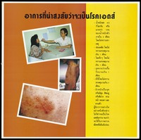 view A doctor places a thermometer in a female patient's mouth, an emaciated man and a skin rash representing a message about symptoms that suggest you have AIDS; one of a series of 4 AIDS education posters by the Population and Community Development Association (PDA) in Thailand. Colour lithograph, ca. 1995.