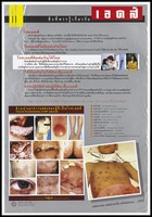 view Twelve illustrated clinical manifestations of HIV infection including oral candidiasis, herpes and Kaposi's sarcoma; part of an AIDS awareness advertisement campaign by the Population and Community Development Association (PDA) in Thailand. Colour lithograph, ca. 199-.