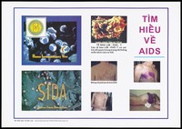 view Typical physical skin complaints caused by the HIV virus that leads to AIDS including rashes, purple blistering, emaciation and open sores; an AIDS prevention advertisement by The Ministry of Education Training, Vietnam. Colour lithograph, ca. 1995.