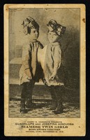 view Harry H. Hargrave presents Guadalupe and Josefina Hinojosa : siamese twin girls born grown together in Havana, Cuba, November 15, 1912.