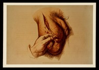 view Photographs of five drawings (in the style of Sir Charles Bell), published in 1820 as plates illustrating surgery of the bowel, scrotum, etc