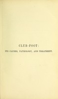 view Club-foot : its causes, pathology and treatment / by William Adams.