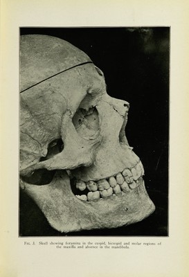 Oral anaesthesia; local anaesthesia in the oral cavity