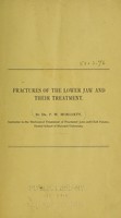 view Fractures of the lower jaw and their treatment / by P.W. Moriarty.