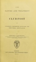 view On the nature and treatment of club-foot : and analogous distortions involving the tibio-tarsal articulation / by Bernard E. Brodhurst.