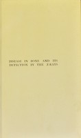 view Disease in bone : and its detection by the x-rays / by Edward W.H. Shenton.