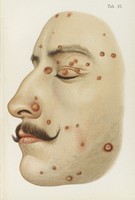 view Coloured illustration of the profile of the face diseased with Syphilis.