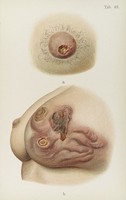 view Coloured illustration of female breast diseased with Syphilis.