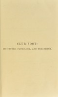 view Club-foot : its causes, pathology and treatment / by William Adams.