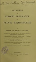 view Lectures on ectopic pregnancy and pelvic haematocele / by Lawson Tait.