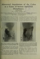 view Abnormal angulations of the colon as a cause of serious intestinal disturbance / by A. Judson Quimby.