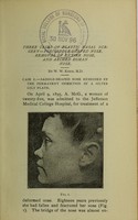 view Three cases of plastic nasal surgery : for saddle-shaped nose, removal of entire nose, and arched Roman nose : a paper read before the Philadelphia County Medical Society, February 26, 1896 / by W.W. Keen.