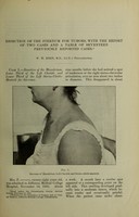 view Resection of the sternum for tumors : with a report of two cases and a table of seventeen previously reported cases / by W.W. Keen.