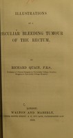 view Illustrations of a peculiar bleeding tumour of the rectum / by Richard Quain.