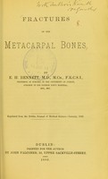 view Fractures of the metacarpal bones / by E.H. Bennett.