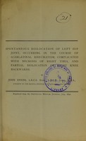 view Spontaneous dislocation of left hip joint, occuring in the course of scarlatinal rheumatism : complicated with necrosis of right tibia, and partial dislocation of right knee backwards / by John Ewens.