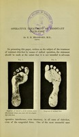 view The operative treatment of resistant club-foot / by E.H. Bradford.