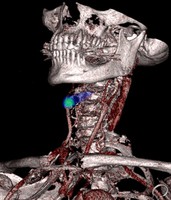 view Advances in stroke treatment.