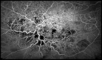 view Central Retinal Vein Occlusion.