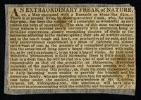 view An extraordinary freak of nature, or, a man encrusted with a barnacle or stone-like skin.