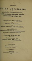 view Operation eines Colon-Carcinoms mit partieller Leberresection, nebst epikritischen Bemerkungen und einer Zusammenstellung analoger Fälle / Johannes Heberlein.