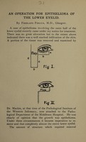 view An operation for epithelioma of the lower eyelid / by Freeland Fergus.