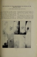 view The detection of pure cholesterine gall-stones by the Roentgen rays / by Dr. Lewis Gregory Cole, New York City.