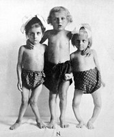 view M0003399: Children showing effects of rickets on physical development and illustrations of the effect of scurvy on joints  /  M0003399EB: Illustrations of the appearance of scurvy in bones