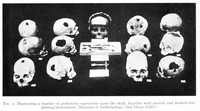 view M0003710: Thirteen skulls showing various methods of trephining