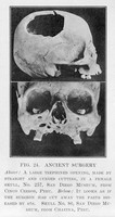 view M0003712: Two skulls with surgery performed on them