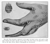 view M0003820: Illustration of a human hand covered in mite bites