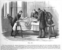 view M0003436: Surgeons performing an operation with the use of Lister carbolic spray