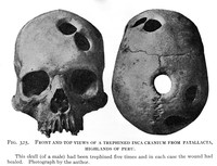 view M0004696: Front and top view of trephined Inca skull