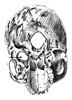 view M0006273: Skull of an Ancient Egyptian showing erosion due to a carotid aneurysm