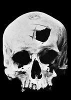 view M0006136: Anterior aspect of Cranium 4 from Huarochiri, showing trephinning