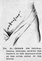 view M0007800: Incision for inguinal hernia, from Cheyne: <i>Antiseptic Surgery</i> (1882)