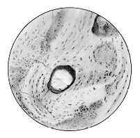 view M0009208: Microscopic study of periphery of large tumor of a dinosaur, from Moodie: <i>Paleopathology</i>