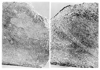 view M0009207: Fossilised Haemangioma, sawn sections through middle of tumour mass of a haemangioma in a dinosaur, from Moodie: <i>Paleopathology</i>