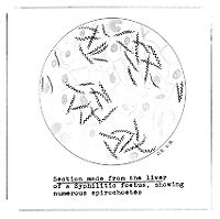 view M0009149: Section made from the liver of a syphilitic foetus