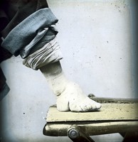 view M0007965: A bound foot demonstrating the Chinese custom of foot binding