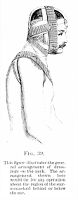 view M0007807: Dressings on the neck, from Cheyne: <i>Antiseptic Surgery</i> (1882)